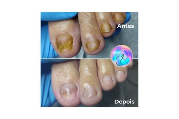 Foto de antes e depois do tratamento 33